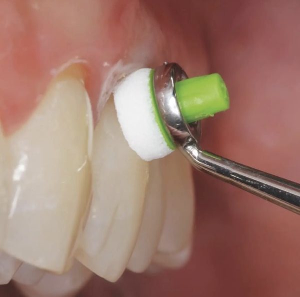 اوپترا اسکالپت OptraSculpt کپی - Image 3