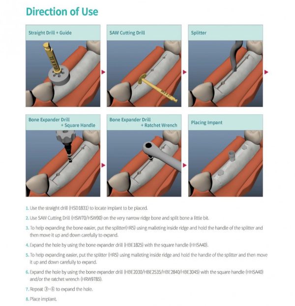 کیت بون اکسپندر هینیم | haenaem Bone expander kit - Image 5